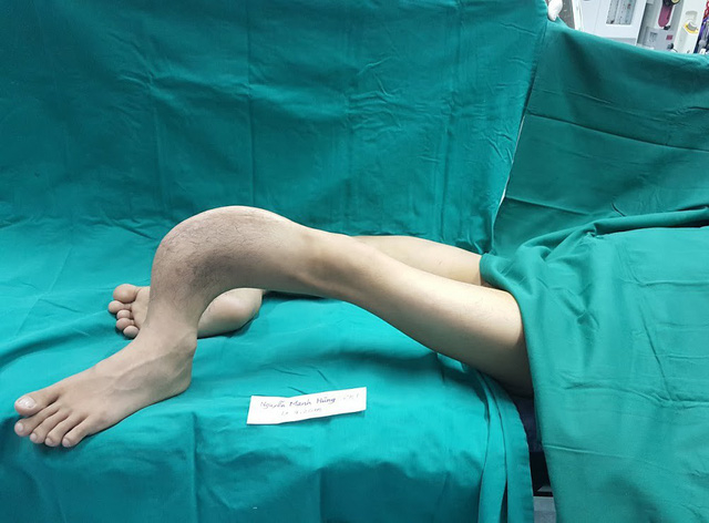 Đ&ocirc;i ch&acirc;n của bệnh nh&acirc;n trước khi được phẫu thuật. Ảnh: BS cung cấp.