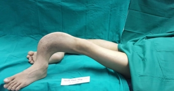 “Kéo dài” đôi chân cong như rễ cây giúp "Hoàng tử ếch" đi lại được sau 28 năm