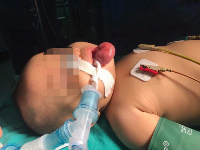 H&igrave;nh ảnh bướu m&ocirc;i của b&eacute; trước khi phẫu thuật.