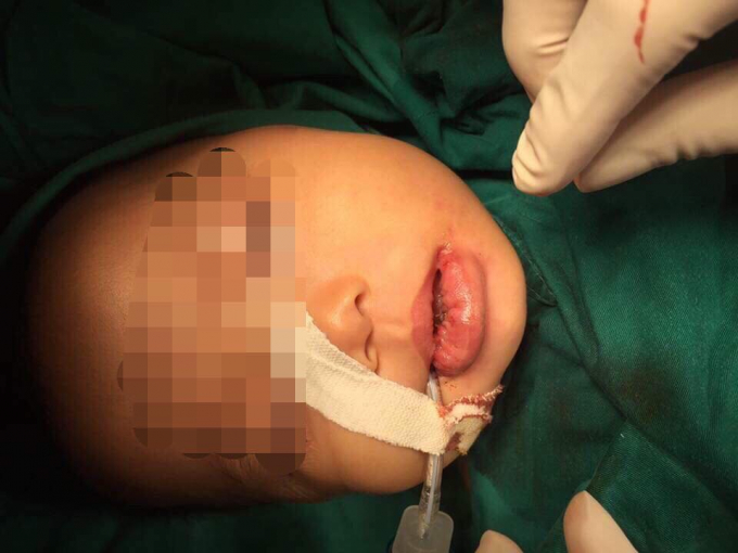 H&Igrave;nh ảnh sau khi phẫu thuật