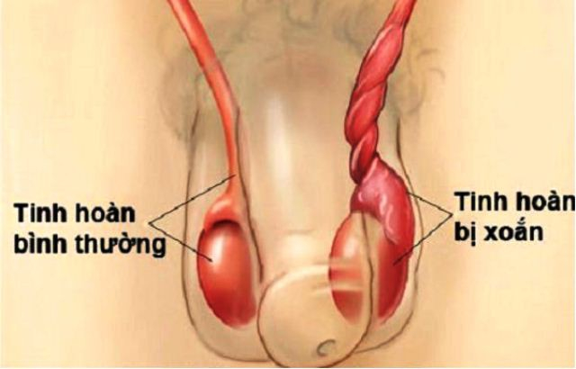 Hai b&eacute; trai 13 tuổi phải cắt bỏ tinh ho&agrave;n v&igrave; ph&ograve;ng kh&aacute;m chẩn đo&aacute;n nhầm