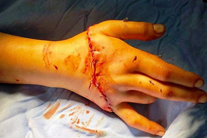 Nỗi th&agrave;nh c&ocirc;ng b&agrave;n tay bị đứt rời cho nạn nh&acirc;n