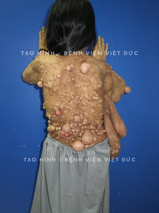 Kinh ho&agrave;ng người phụ nữ mọc u to&agrave;n th&acirc;n chi ch&iacute;t như quả sung