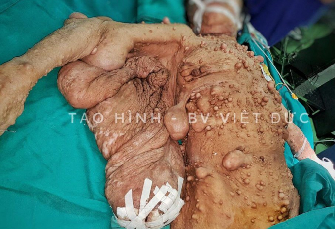 Kinh ho&agrave;ng người phụ nữ mọc u to&agrave;n th&acirc;n chi ch&iacute;t như quả sung