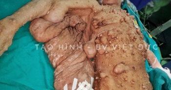 Kinh hoàng người phụ nữ mọc u toàn thân chi chít như quả sung