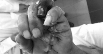 Thợ mộc bị máy cưa cắt lìa bàn tay