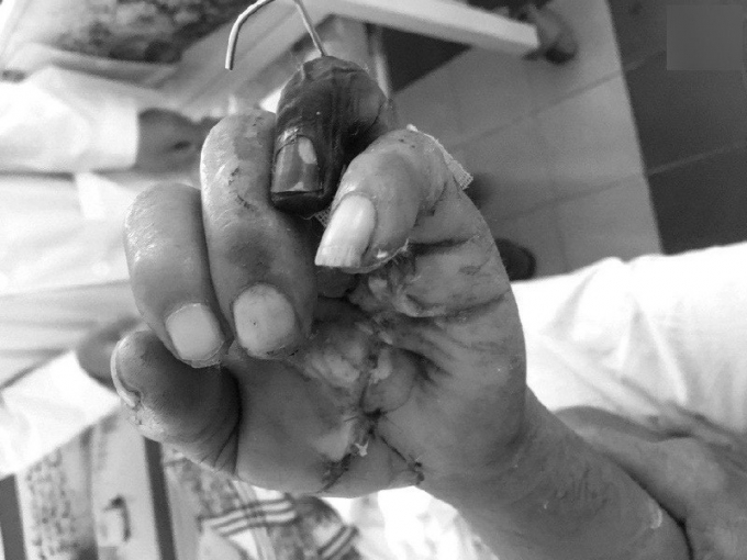 Tai nạn lao động thường để lại những thương t&iacute;ch nặng nề tạo g&aacute;nh nặng cho gia đ&igrave;nh, x&atilde; hội