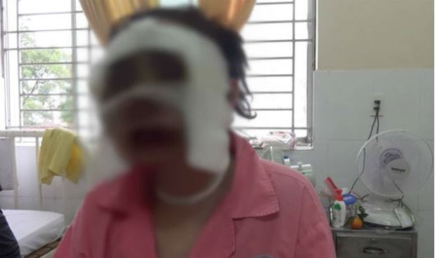 Nạn nh&acirc;n đang được điều trị tại bệnh viện Chợ Rẫy. Ảnh NLĐ