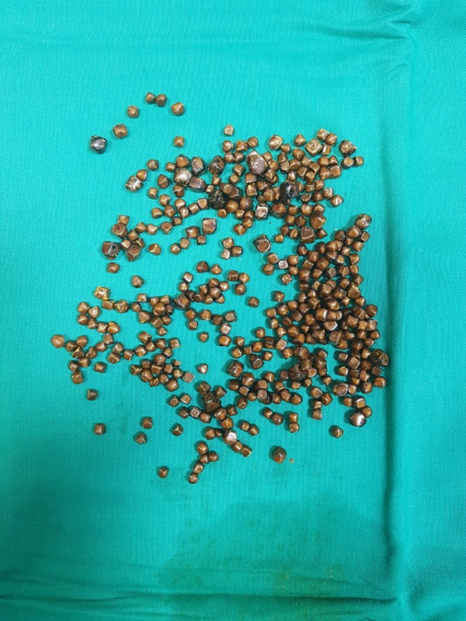 Hoảng hồn b&aacute;c sĩ l&ocirc;i ra 400 vi&ecirc;n sỏi trong t&uacute;i mật bệnh nh&acirc;n