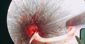 Hóc xương cá dài 4 cm, đến “bà mo” chữa nhiều ngày nhưng không khỏi