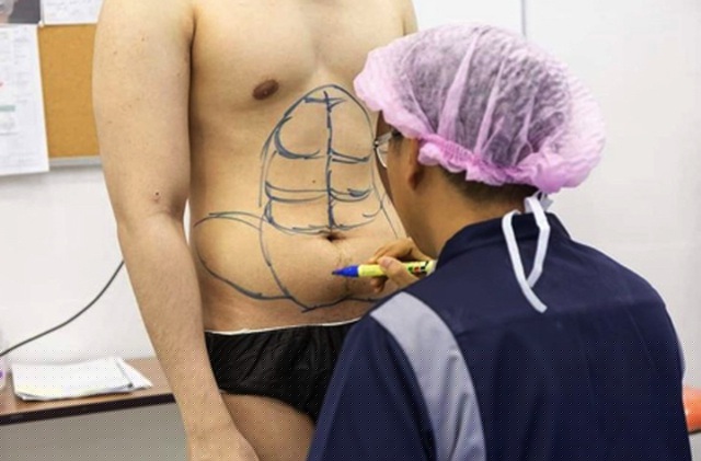 Chuẩn bị phẫu thuật tạo cơ bụng