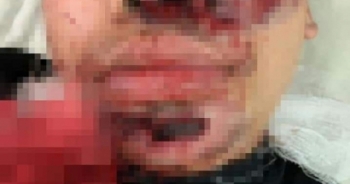 Một người nhập viện do điện thoại nổ trong lúc đang sạc pin