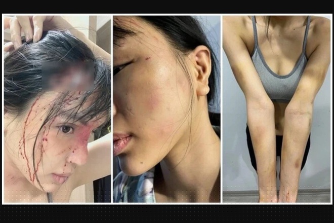 Hình ảnh siêu mẫu Khả Trang tố bị chồng sắp cưới bạo lực, hành hung (Ảnh: ANTĐ).