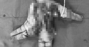 Nát tay trái do nổ điện thoại