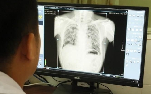 Thêm 57 người từng làm tại Công ty Châu Tiến mắc bệnh do bụi phổi