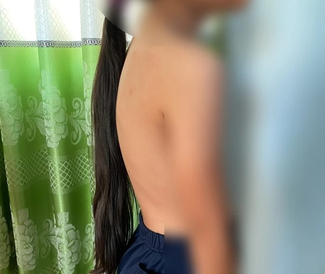 Học sinh được chẩn đoán cong, vẹo cột sống sau buổi khám sàng lọc bốn bệnh tật học đường. (Ảnh: Hồng Điệp/TTXVN)